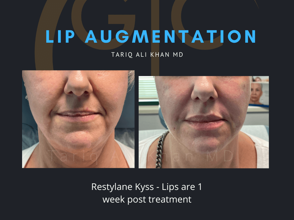 Gentle Care Laser Tustin & Long Beach Before and After picture - Lip Augmentation